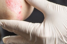 Read more about the article Psoriasis and Medical Cannabis